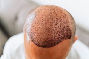 Leia mais sobre o artigo Tratamento pós transplante capilar